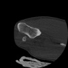 SPORK, NICO - 22.03.1976 - 02.08.2022 - CT obere Extremität - 17:51:17